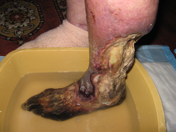 En bild på ett stort sår (kallbrand) på vänster underben och fot.